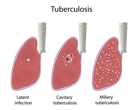 Tuberculosis .